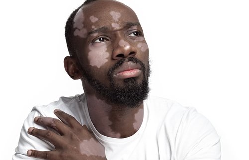 Vitiligo on hand
